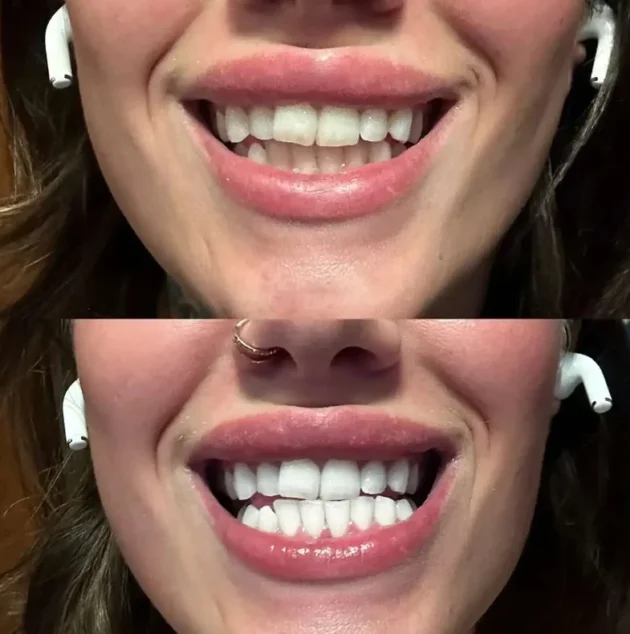 هاي سمايل معجون تبييض الاسنان الصفراء V34 8