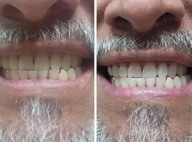 هاي سمايل معجون تبييض الاسنان الصفراء V34 9