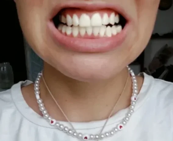 هاي سمايل معجون تبييض الاسنان الصفراء V34 11