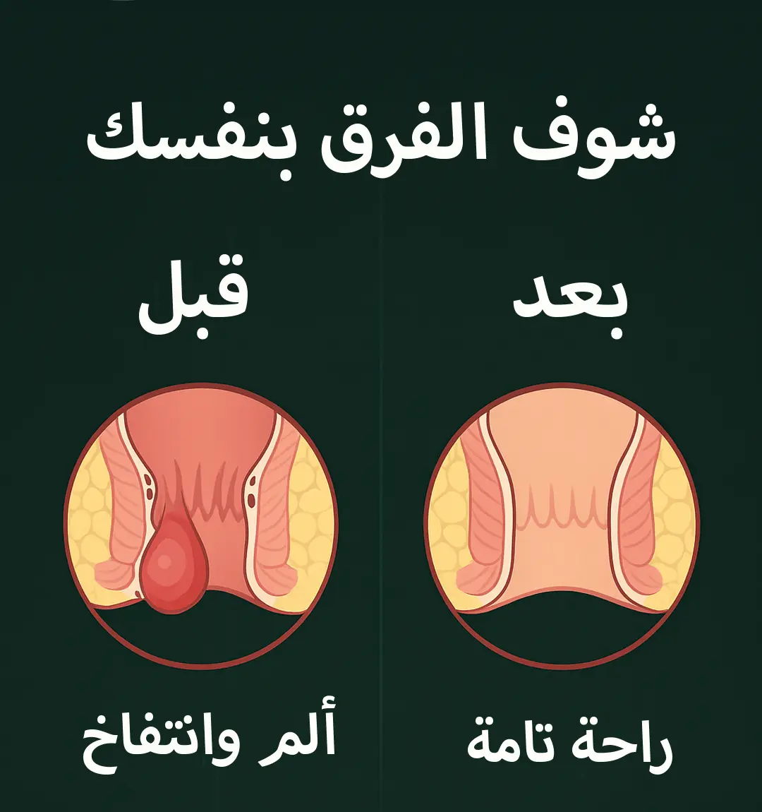 بخاخ البواسير الطبيعي للبواسير الداخلية والخارجية 9